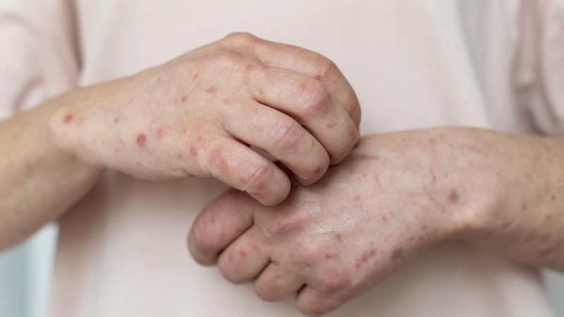 В Україні різко зросла захворюваність на кір