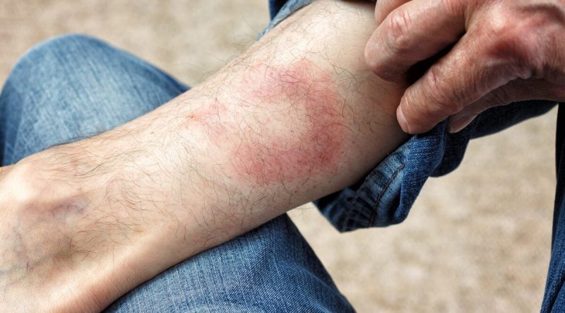 Як убезпечити себе від хвороби Лайма під час сезону кліщів